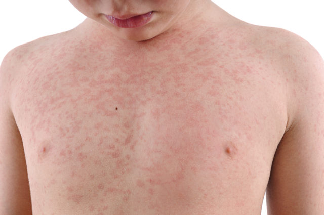 Side effects after lung cancer treatment